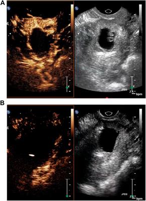 Clinical Assessment of Ultrasound-Guided Local Lauromacrogol Injection Combined With Curettage and Hysteroscopy for Cesarean Scar Pregnancy